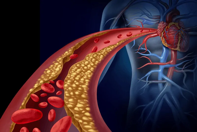 “Лошият” холестерол увеличава риска от сърдечни заболявания