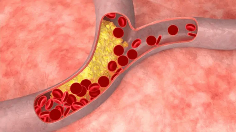 Важно при повишен холестерол – 5-те най-опасни последици