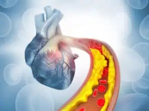 Имам висок холестерол