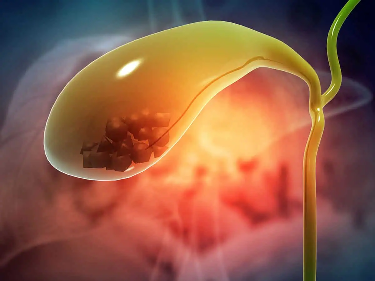 Камъни в жлъчката