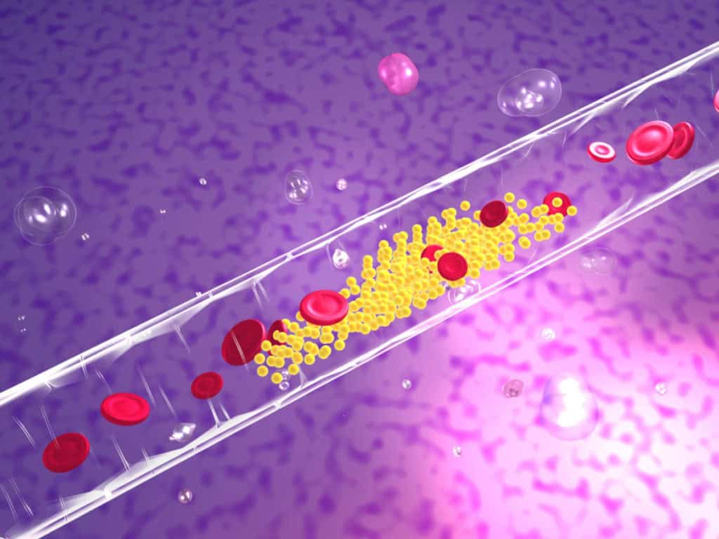 плаки в кръвоносните съдове