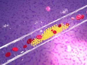 плаки в кръвоносните съдове