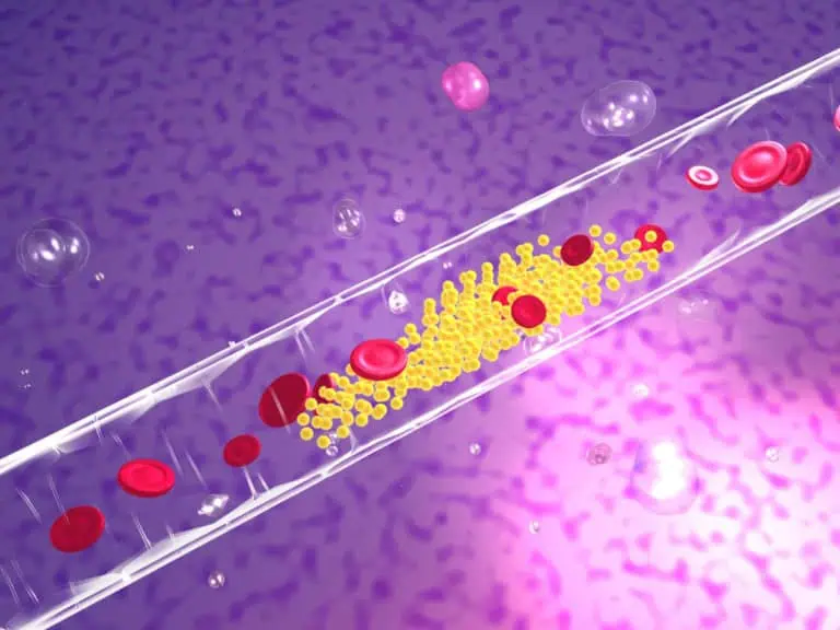 плаки в кръвоносните съдове