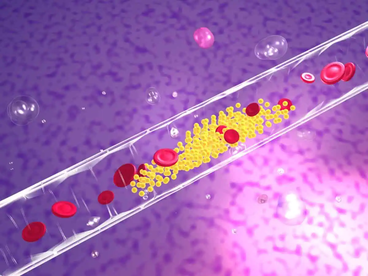 плаки в кръвоносните съдове