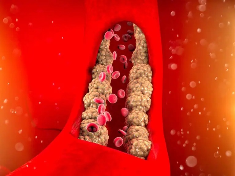 Защо се вдигат триглицеридите?